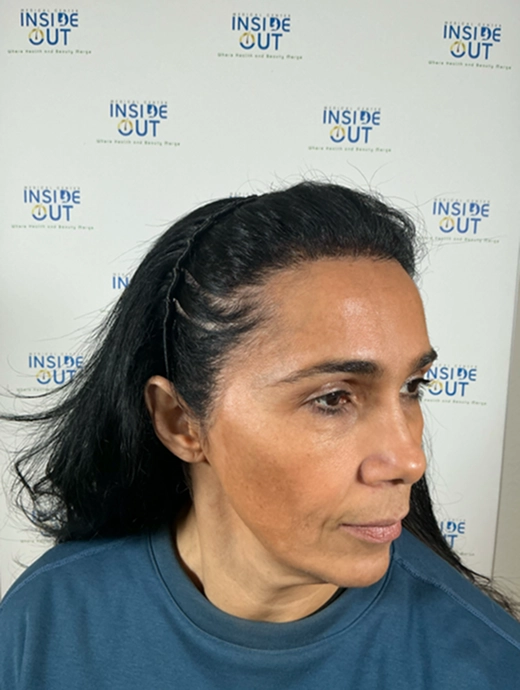 Women's Hair Transplant — Female hair restoration — patient at Inside Out Medical Center, Fresno