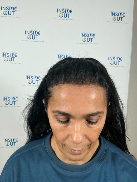 Women's Hair Transplant — Female hair restoration — patient at Inside Out Medical Center, Fresno