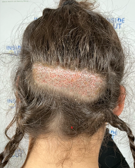 Women's Hair Transplant — Female hair restoration — patient at Inside Out Medical Center, Fresno