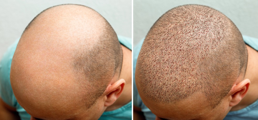 Invest in Lasting Hair and Confidence