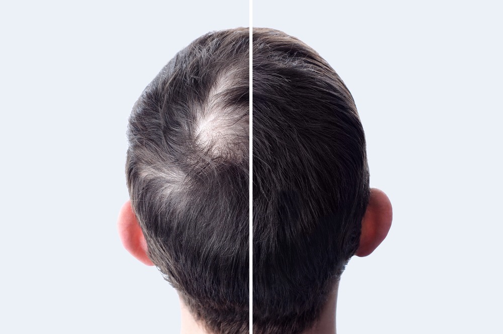 How to Finance Your Hair Restoration Surgery