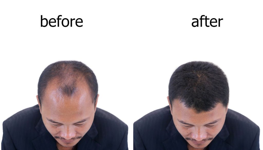 A man with thinning hair on the top of his head in the left image labeled before and with fuller, thicker hair in the right image labeled after. Both images show him looking down in a suit jacket.