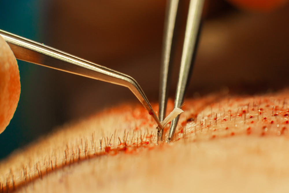 Close-up of two tweezers inserting a hair graft into the scalp during a hair transplant procedure, with small red dots and newly implanted hairs visible on the skin.