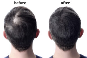 Side-by-side photos of the back of a person’s head. The left image labeled “before” shows thinning hair on the crown, while the right image labeled “after” shows fuller, thicker hair in the same area.